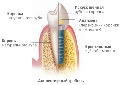 Дентальная имплантология