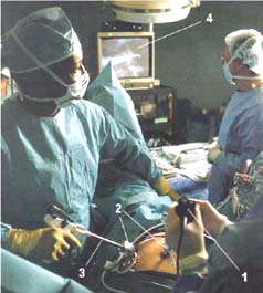Лапароскопическая холецистэктомия - Как протекает лапароскопическая операция