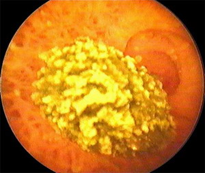 Одиночный камень в желчном пузыре - Лапароскопическая микрохирургическая холецистолитомия