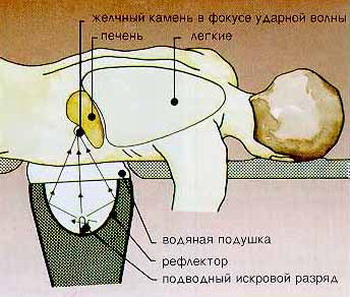 ЛИТОТРИПСИЯ - Схема проведения сеанса литотрипсии