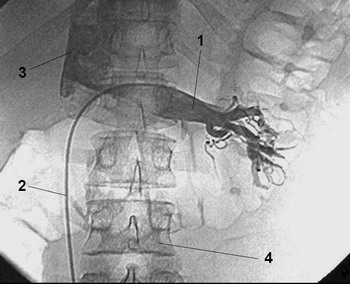 ВАРИКОЦЕЛЕ - Рентгеновская эндоваскулярная операция при варикоцеле 