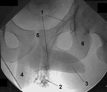 ВАРИКОЦЕЛЕ - Рентгеновская эндоваскулярная операция при варикоцеле 